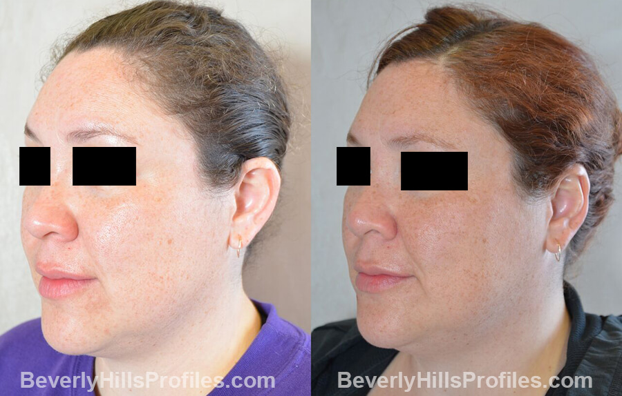 photos female patient before and after Otoplasty Procedures - left oblique view