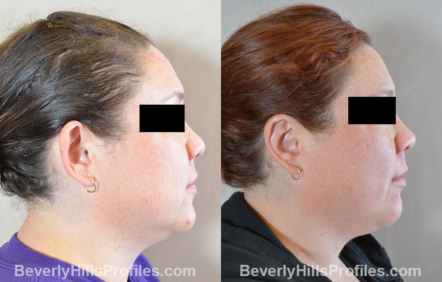 photos female patient before and after Otoplasty Procedures - right side view