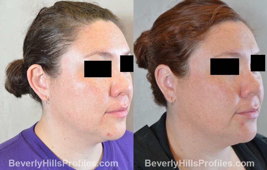 photos female patient before and after Otoplasty Procedures - oblique view