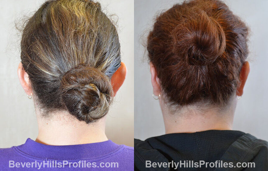 photos female patient before and after Otoplasty Procedures - back view