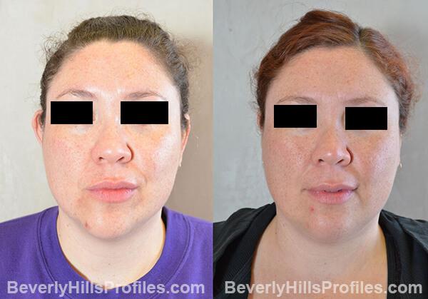 photos female patient before and after Otoplasty Procedures