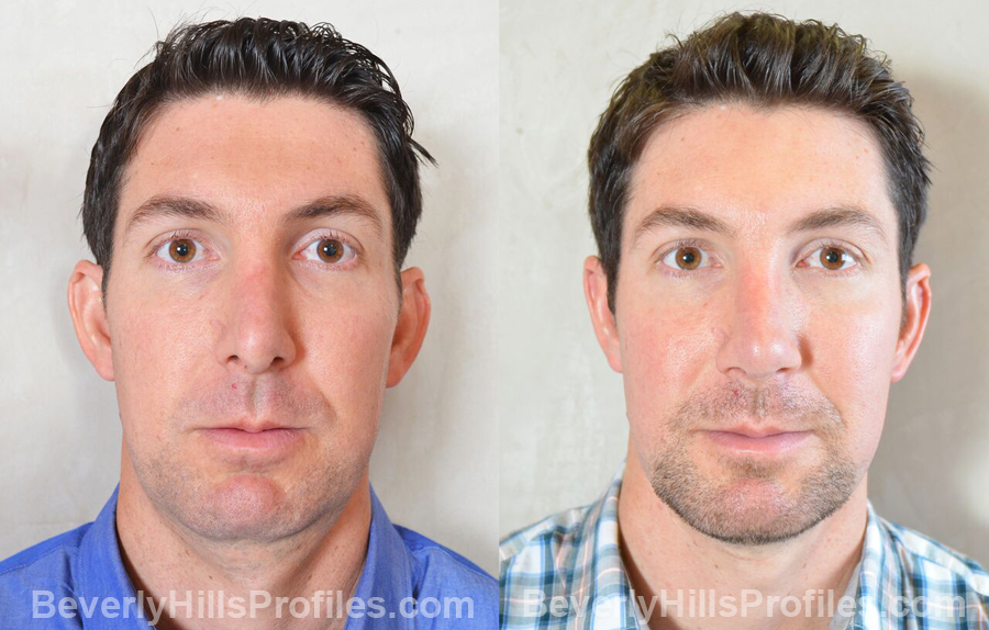 photos male patient before and after Otoplasty Procedures - front view