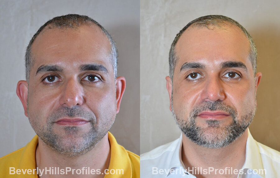 Male patient before and after Otoplasty - front view