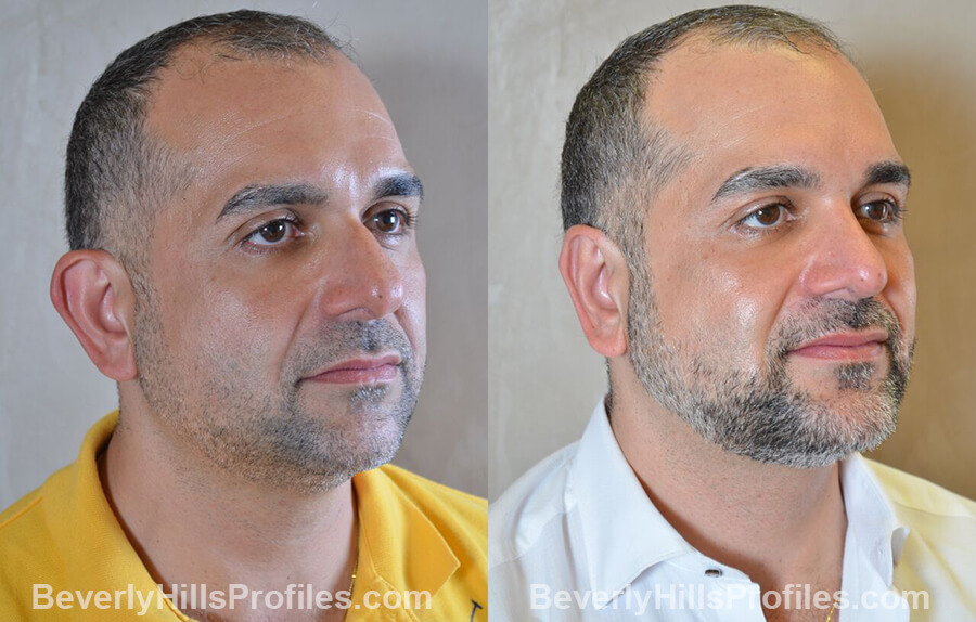 Male before and after Otoplasty - oblique view
