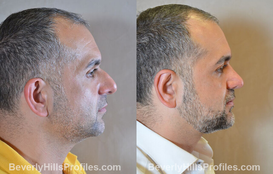 Male before and after Otoplasty, oblique view