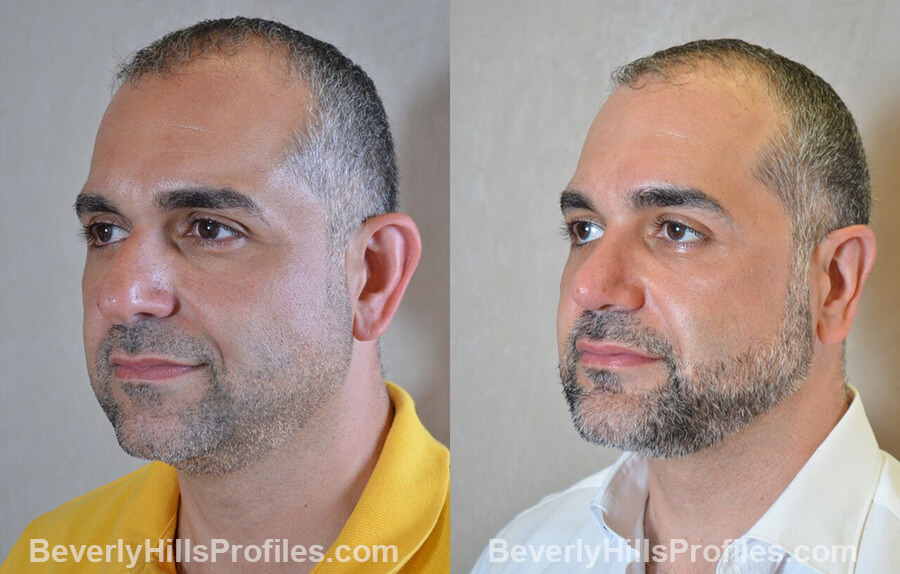 Male before and after Otoplasty - view