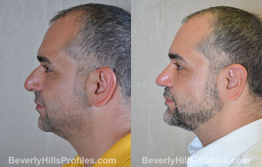 Male before and after Otoplasty - side view