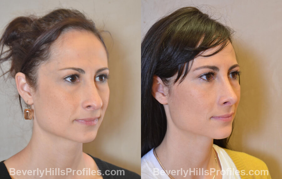 Photos Female before and after Revision Nose Job, oblique view