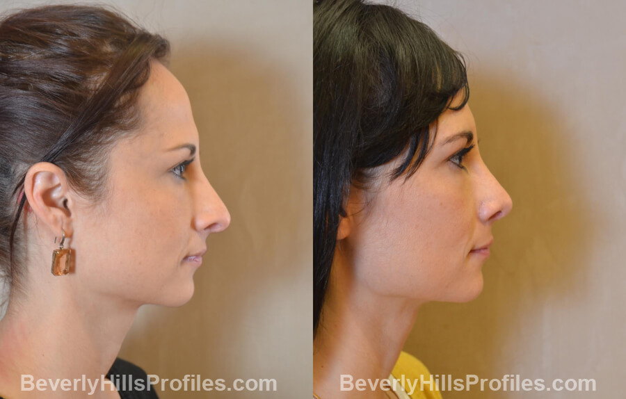 Photos Female before and after Revision Nose Job, side view