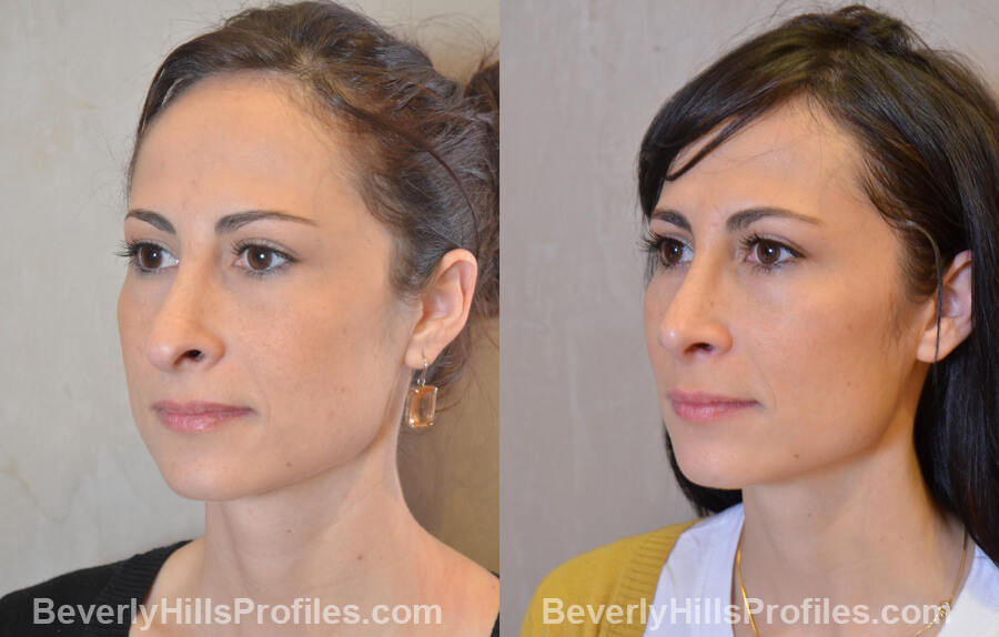 Photos Female before and after Revision Nose Job, left oblique view