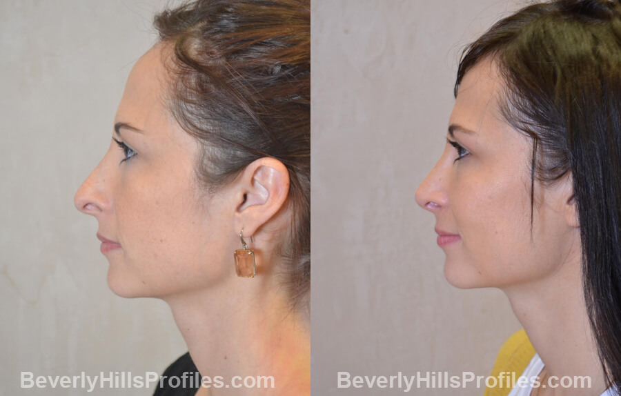 Photos Female before and after Revision Nose Job, left side view
