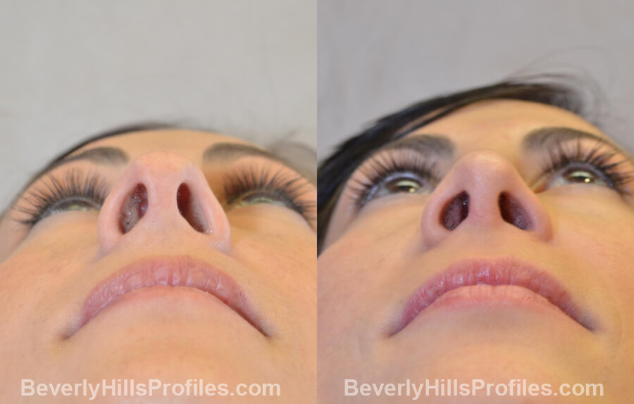 Photos Female before and after Revision Nose Job, underside view