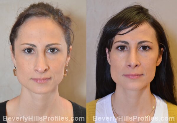 Revision Rhinoplasty Before and After Photo Gallery - front view, female patient 32
