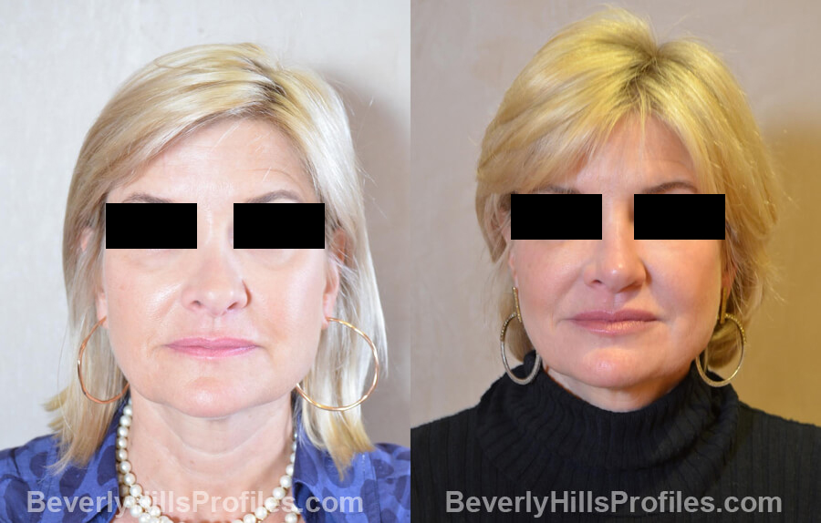 Photos Female patient before and after Revision Nose Job, front view