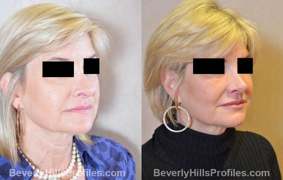 Photos Female patient before and after Revision Nose Job, oblique view