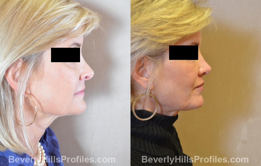 Photos Female patient before and after Revision Nose Job, side view