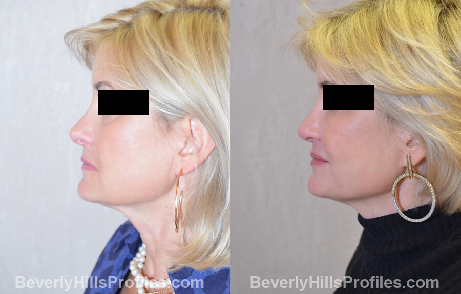 Photos Female patient before and after Revision Nose Job, left oblique view