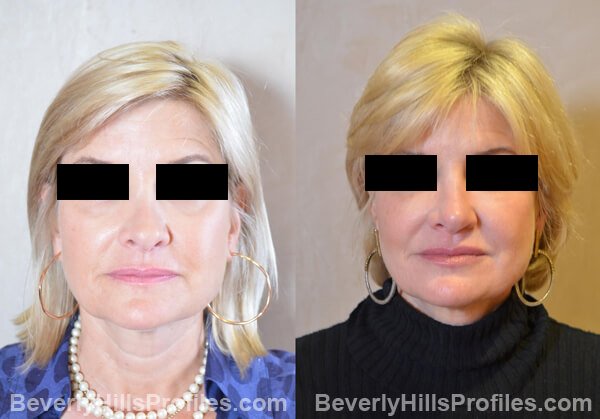 Revision Rhinoplasty Before and After Photo Gallery - front view, female patient 33