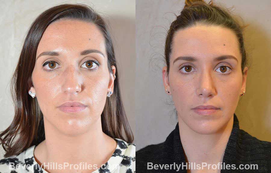 imgs Female patient before and after Nose Surgery Procedures - front view