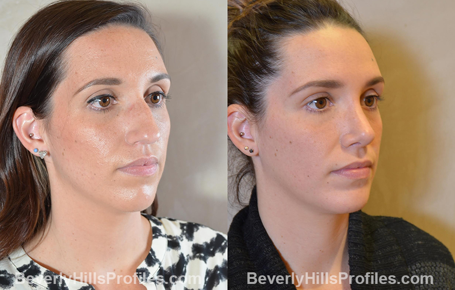 Female patient before and after Chin Implants - oblique view