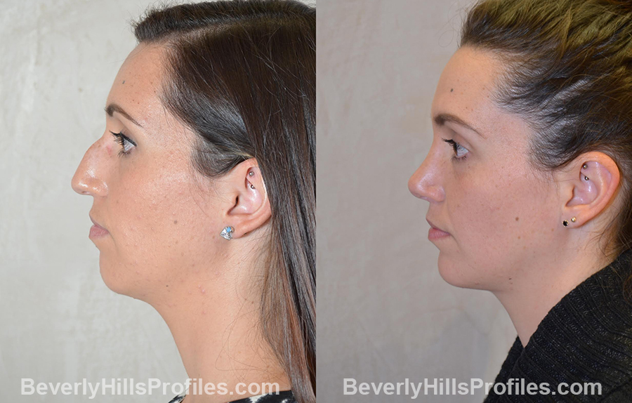 Female patient before and after Chin Implants - side view