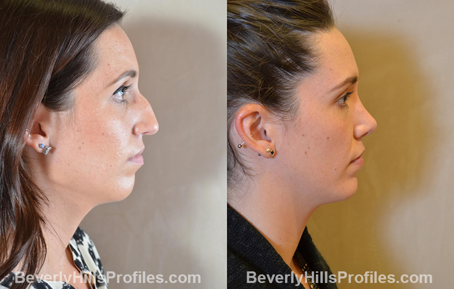 Female patient before and after Chin Implants - right side view