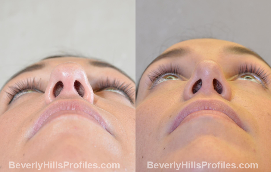 Female patient before and after Chin Implants