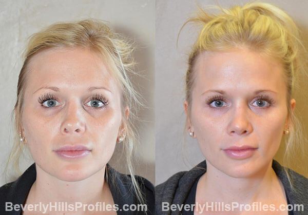 Revision Rhinoplasty Before and After Photo Gallery - front view, female patient 35