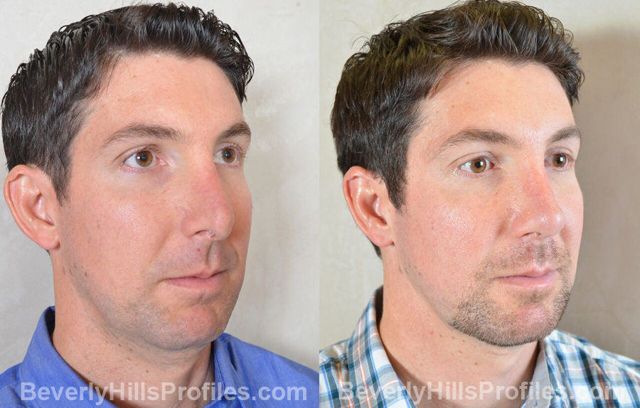 Photos Male before and after Revision Rhinoplasty - oblique view