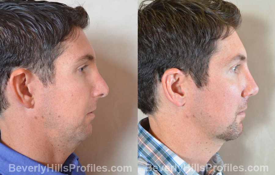 Photos Male before and after Revision Rhinoplasty - side view