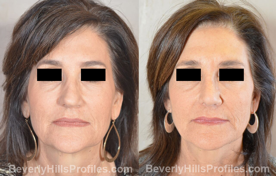 Female patient before and after Revision Nose Job - front view