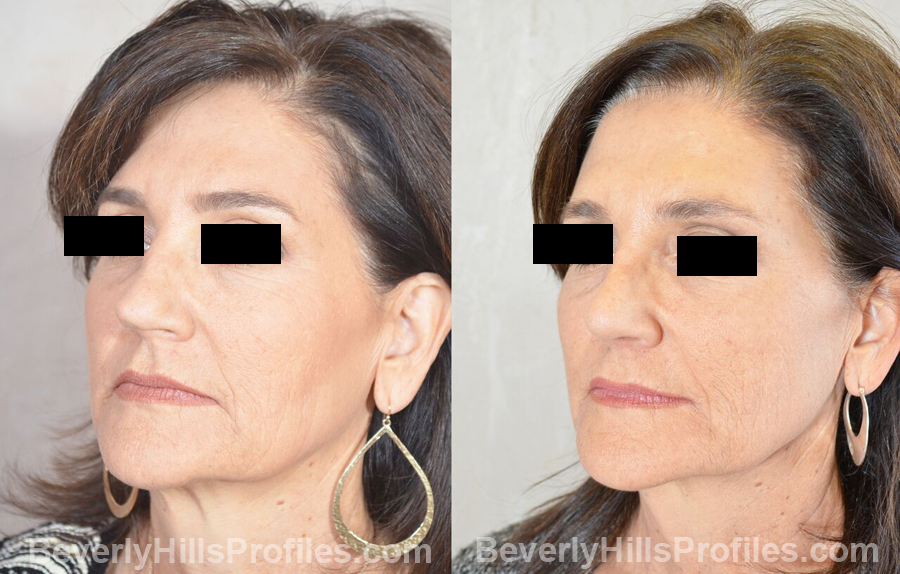 Female patient before and after Revision Nose Job - oblique view