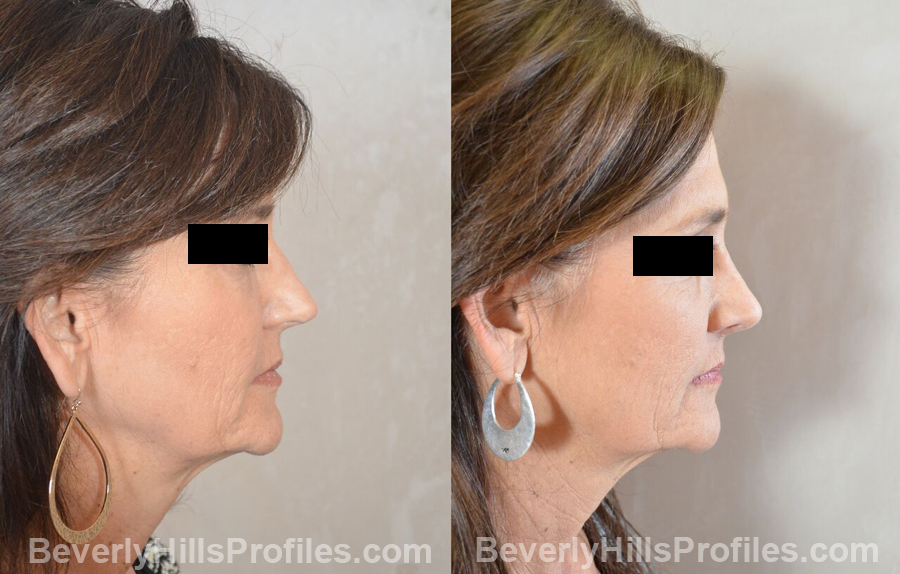 Female patient before and after Revision Nose Job - side view