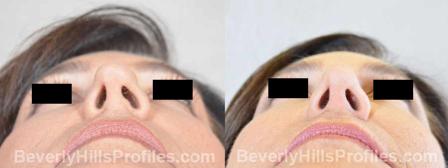 Female patient before and after Revision Nose Job - underside view