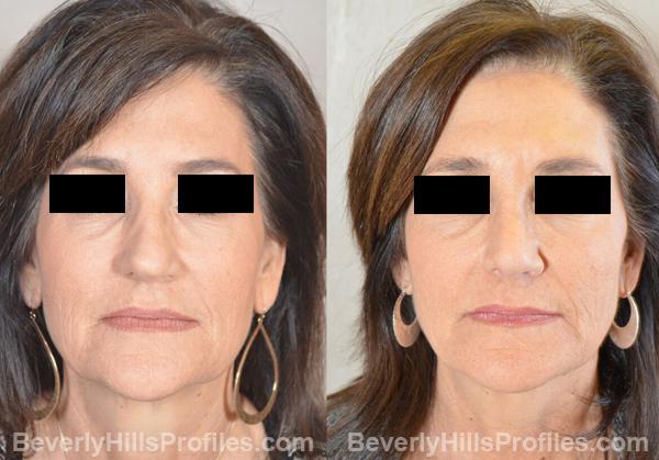 Revision Rhinoplasty Before and After Photo Gallery - front view, female patient 29