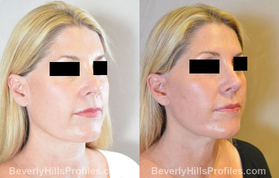 Images Female patient before and after Revision Nose Surgery oblique view