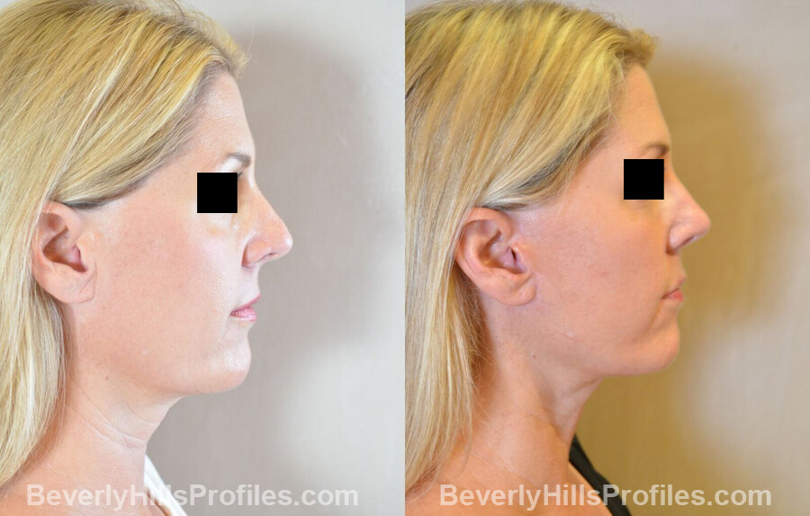 Images Female patient before and after Revision Nose Surgery side view