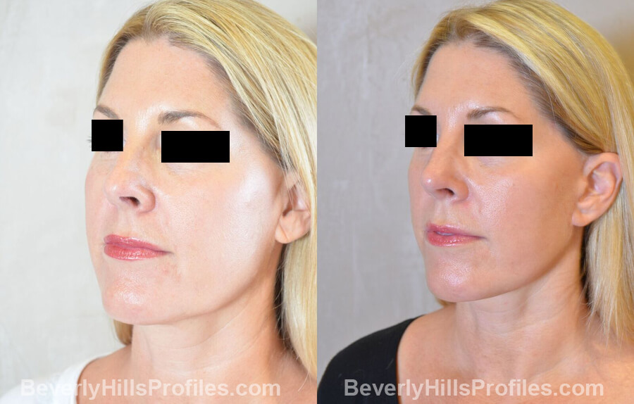 Images Female patient before and after Revision Nose Surgery left oblique view