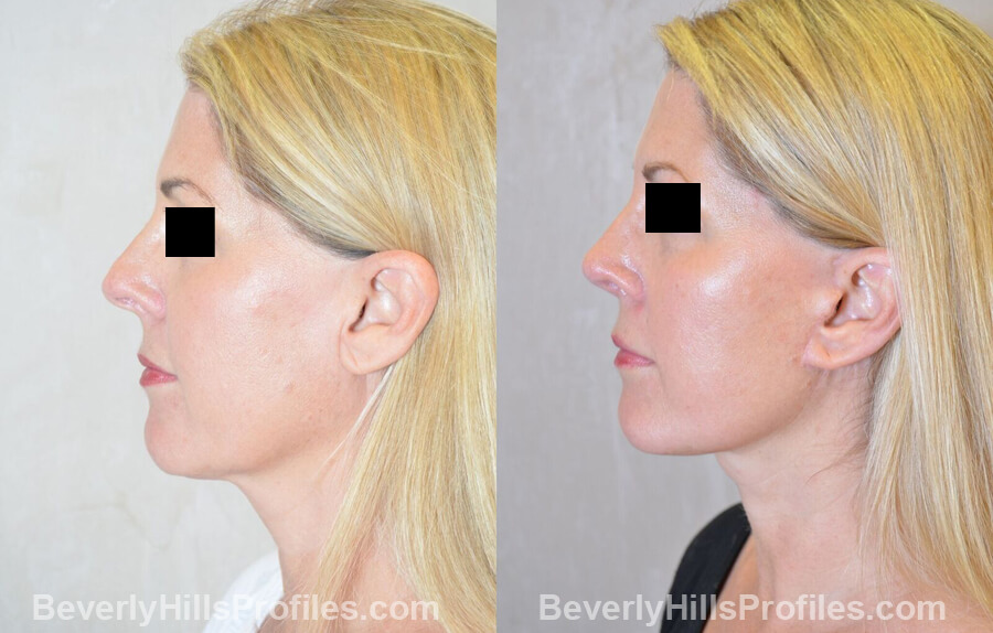 Images Female patient before and after Revision Nose Surgery left side view