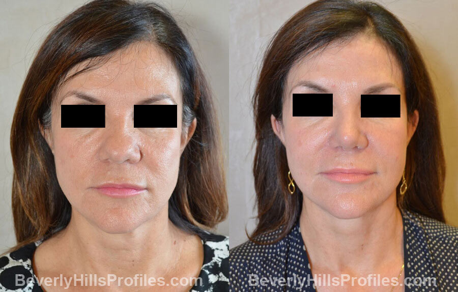 Photos Female before and after Revision Nose Surgery, front view