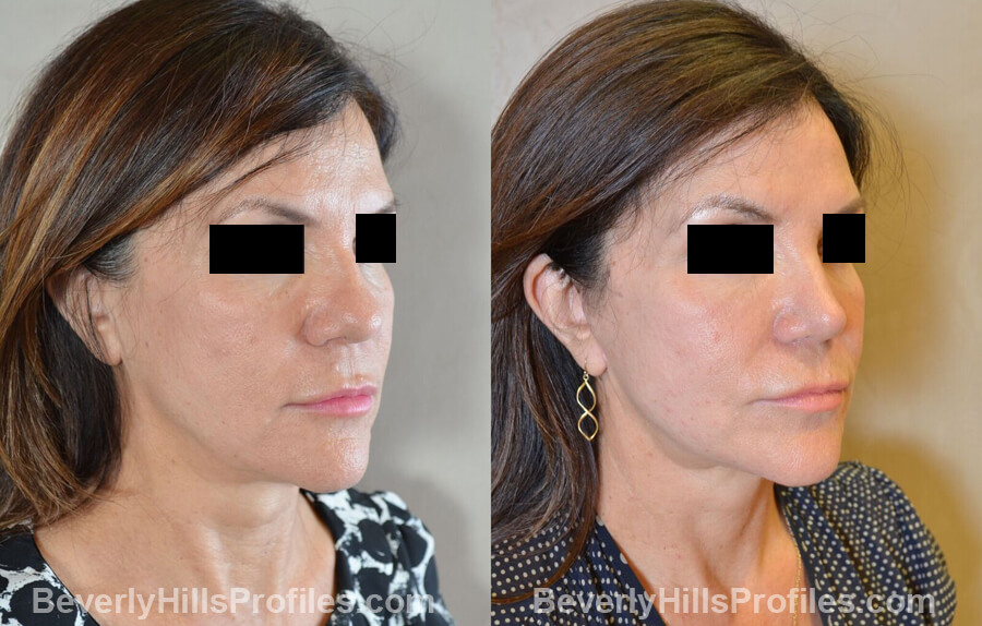 Photos Female before and after Revision Nose Surgery, oblique view