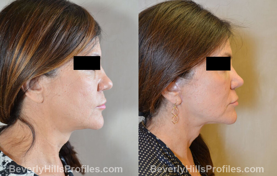 Photos Female before and after Revision Nose Surgery, side view