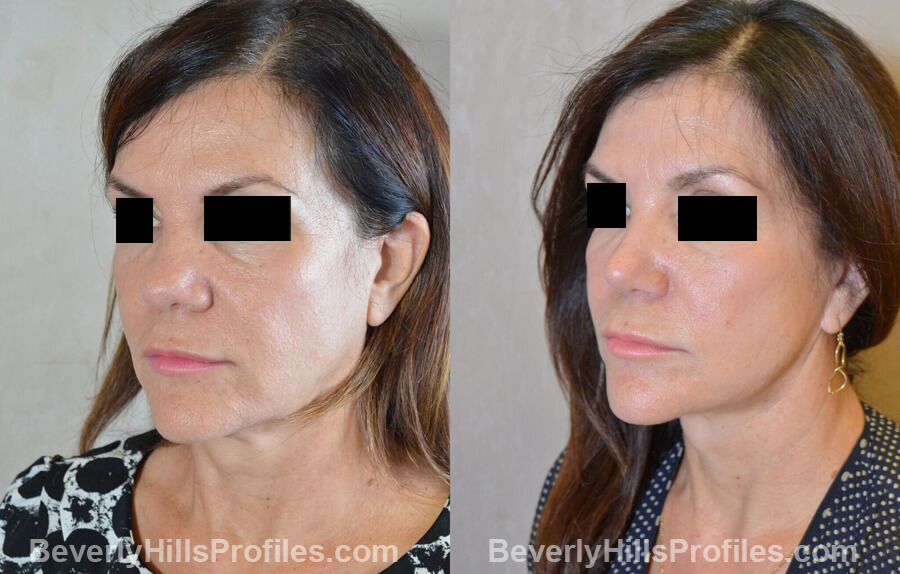 Photos Female before and after Revision Nose Surgery, left oblique view