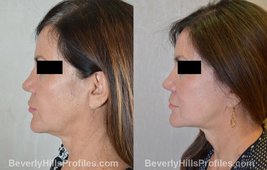 Photos Female before and after Revision Nose Surgery, left side view