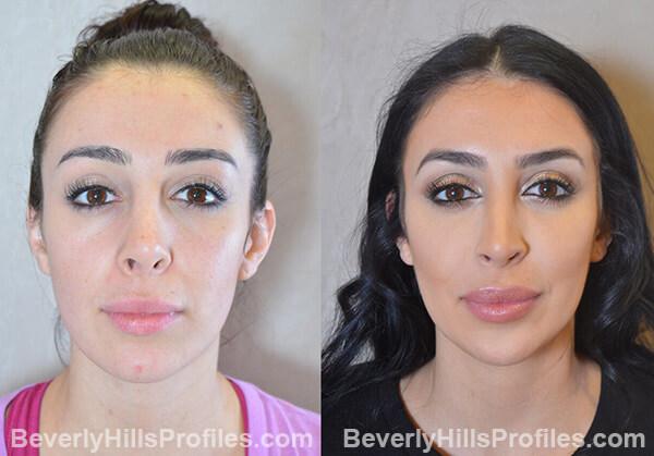Revision Rhinoplasty Before and After Photo Gallery - front view, female patient 11