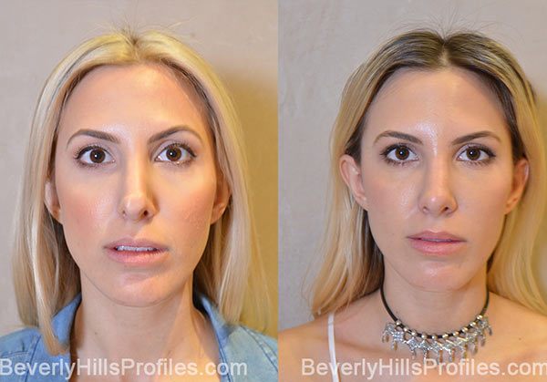 Revision Rhinoplasty Before and After Photo Gallery - front view, female patient 9
