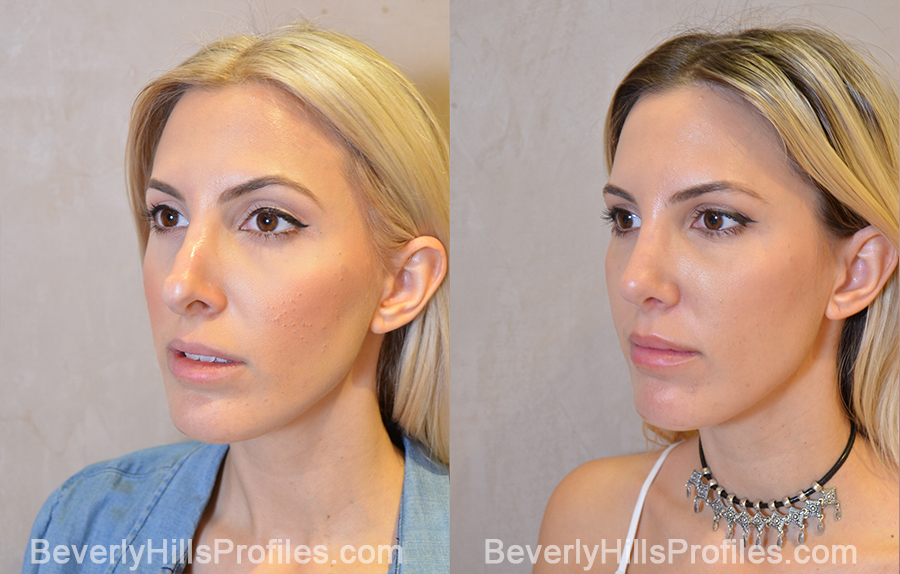 left oblique view - Female patient before and after Revision Rhinoplasty