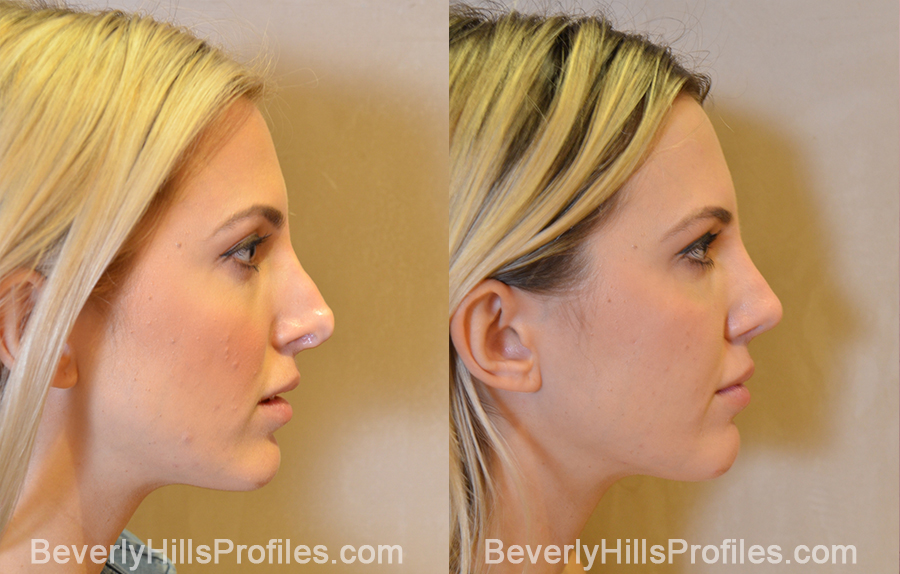 side view - Female patient before and after Revision Rhinoplasty