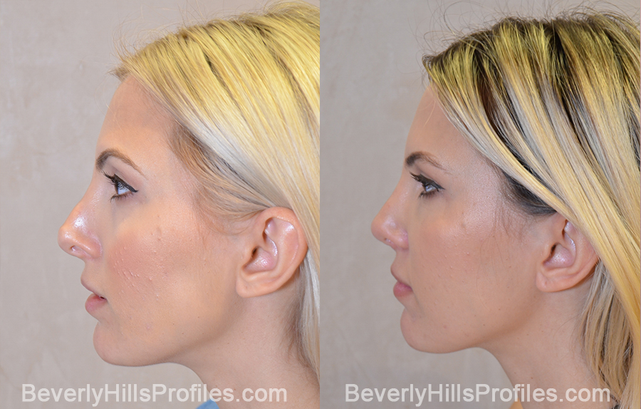 left side view - Female patient before and after Revision Rhinoplasty