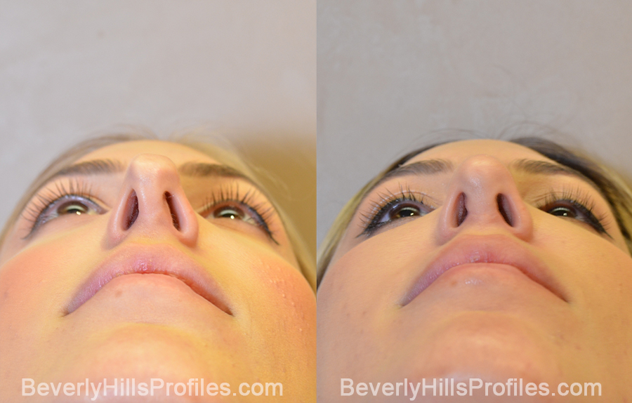 underside view - Female patient before and after Revision Rhinoplasty